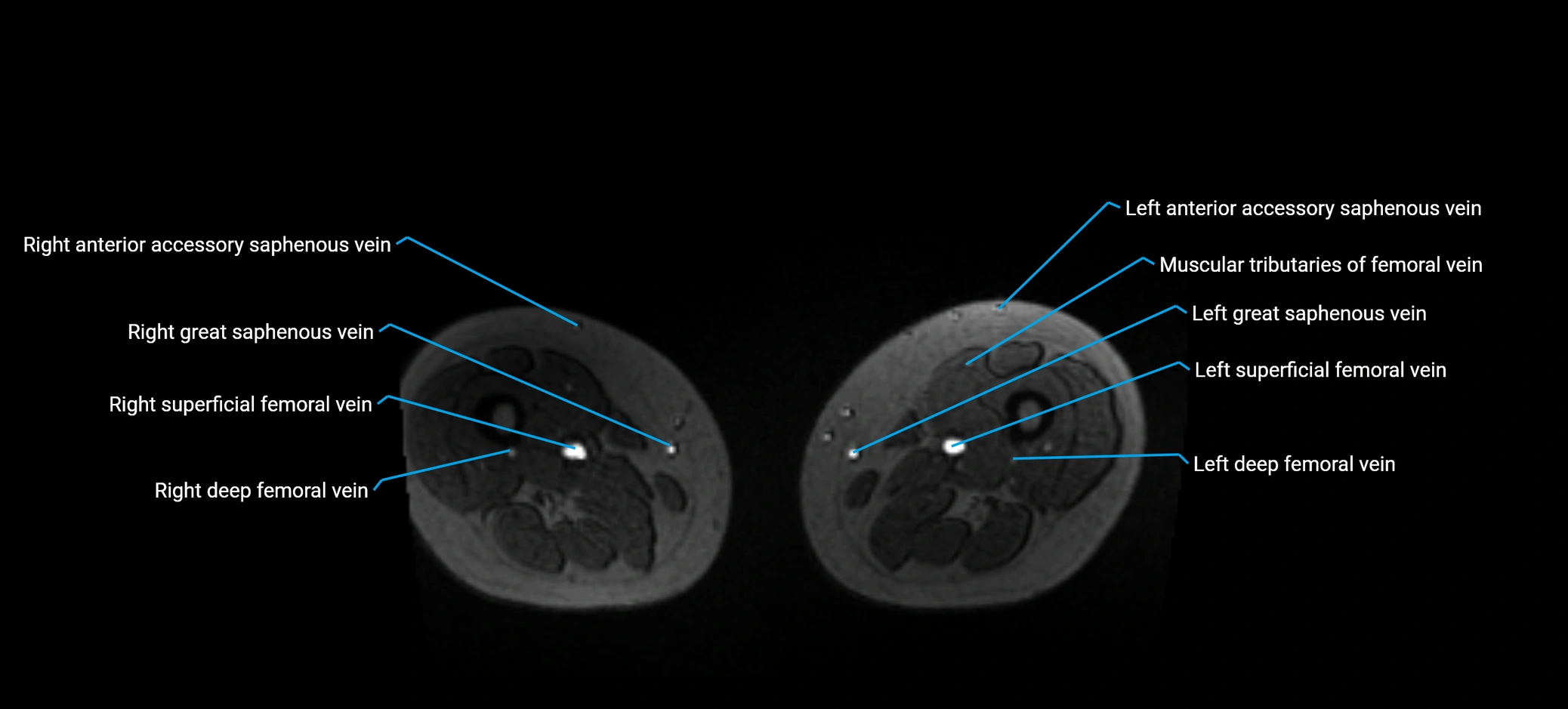 MRV abdomen pelvis & lower limb axial cross sectional anatomy labelled MRI image 292 (1).webp